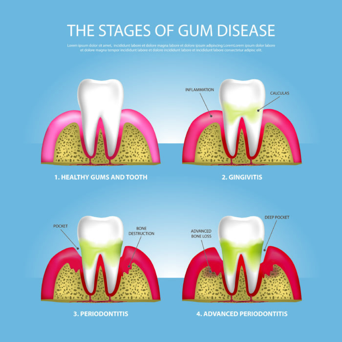 A cross section of a tooth showing the 4 stages of gum disease